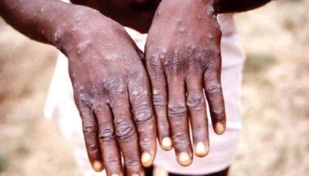 ganada m cicegi vaka sayisi 565e cikti C89hKWYY